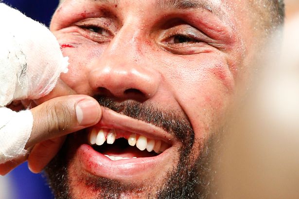 James-DeGale-reveals-missing-teeth-after-the-fight.jpg