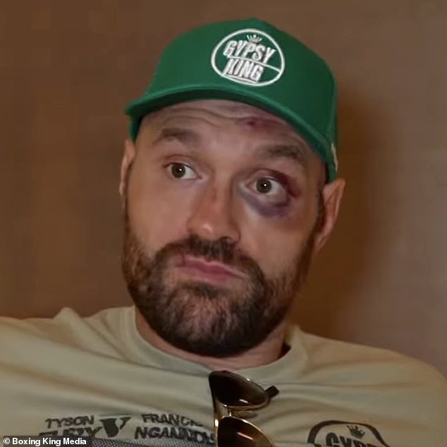 77157033-12686693-Tyson_Fury_showed_off_his_battered_and_bruised_face_following_.jpg